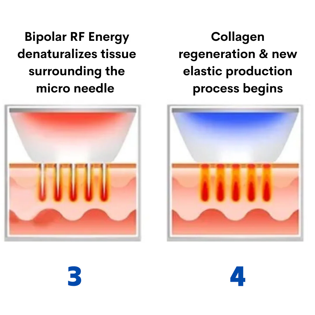 Beauty Disruptor™ RF Microneedling Machine 3 in 1 - Image 5