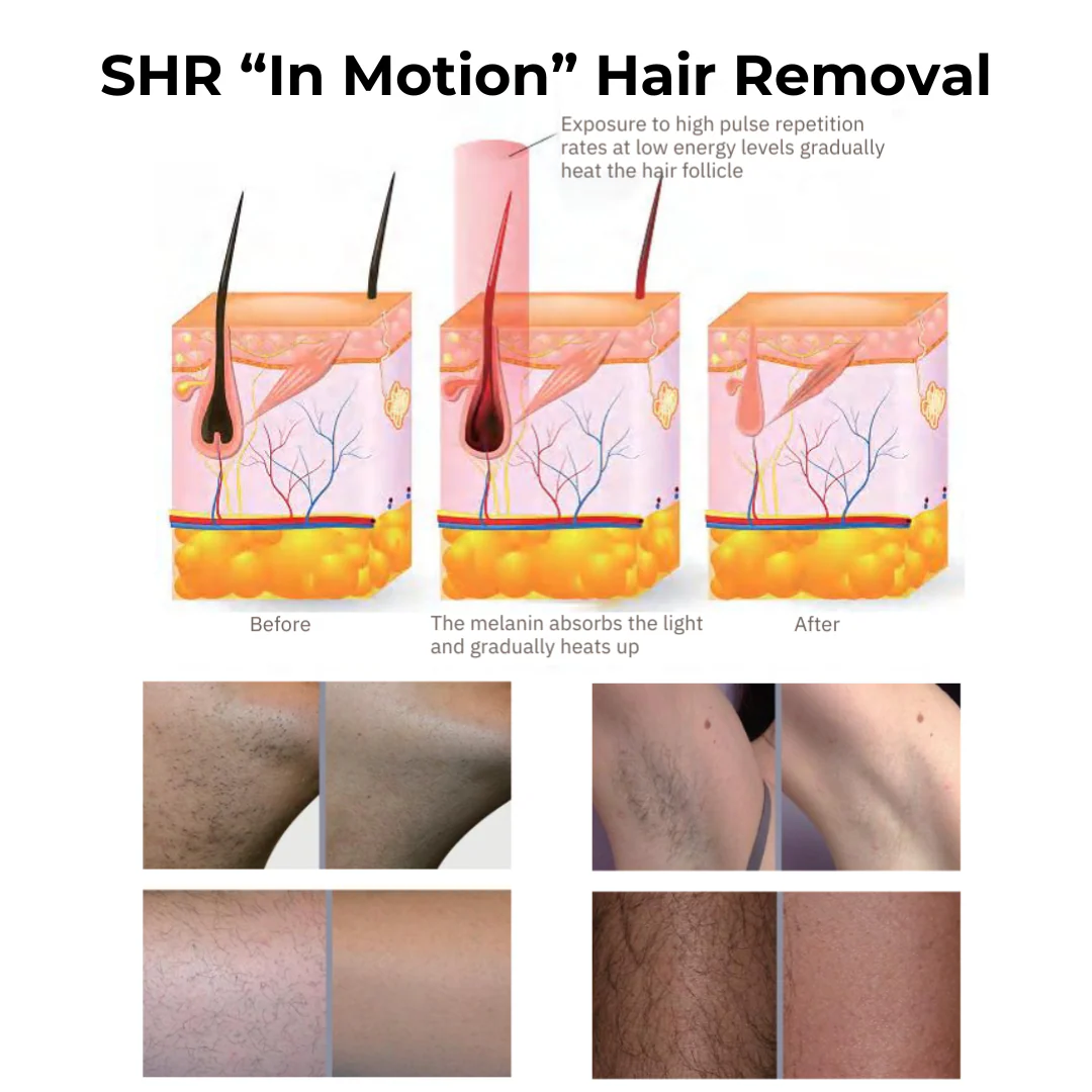 DermaLaze™ Delicate PRO 3 in 1 E-Light Skin Rejuvenation System - Image 7