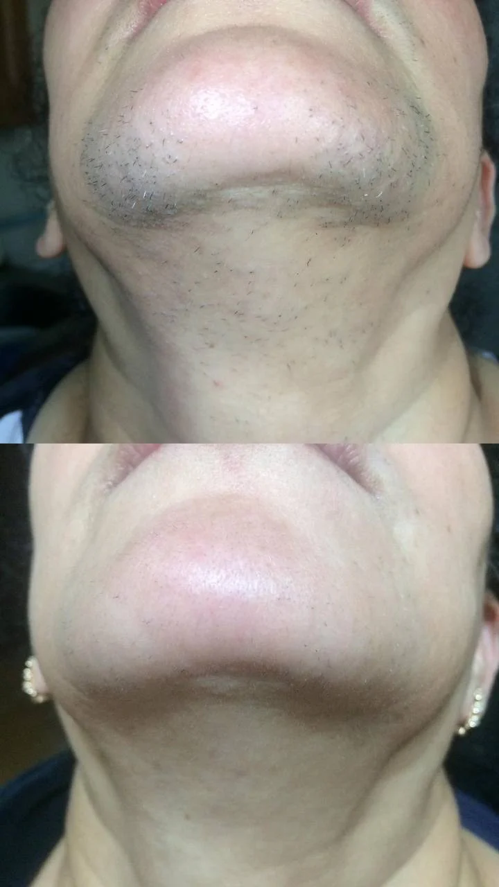Elite Smooth™ Hair Removal Diode Laser Portable - Image 5