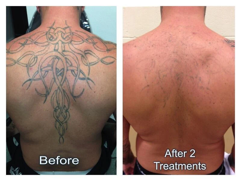 PicoErase® Tattoo Removal Laser Machine - Image 5